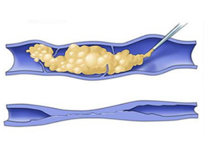 Sclerotherapy spider vein treatment