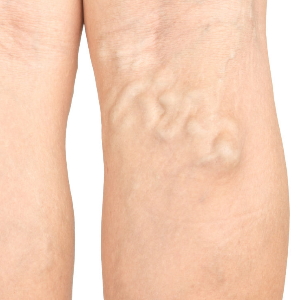 Varicose Veins