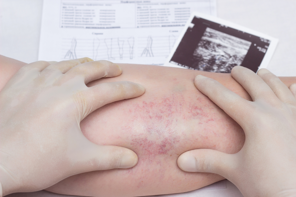 varicose veins treatment