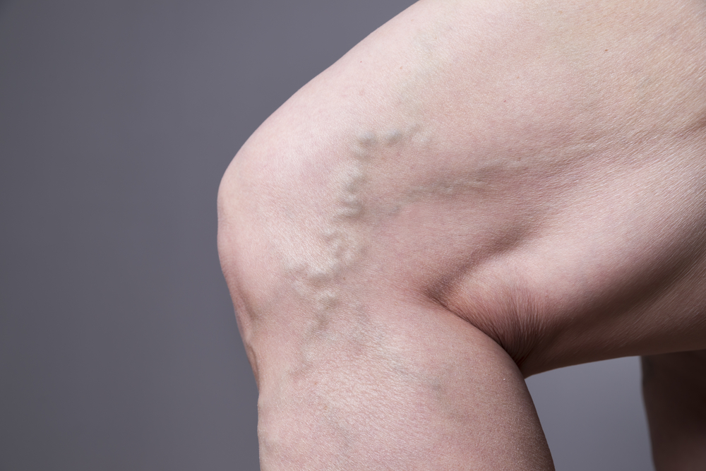 varicose veins